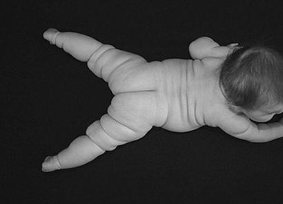 Паратрофия - избыточный вес у младенцев